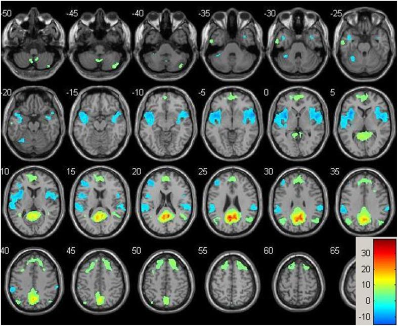 https://cdn.ncbi.nlm.nih.gov/pmc/blobs/0e3a/4353252/8d846688f93d/fnagi-07-00014-g0001.jpg