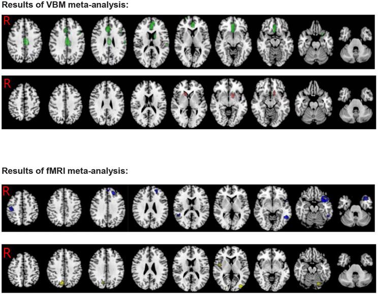 https://cdn.ncbi.nlm.nih.gov/pmc/blobs/0eeb/9853532/ab126e402f44/fpsyt-13-1070142-g0002.jpg