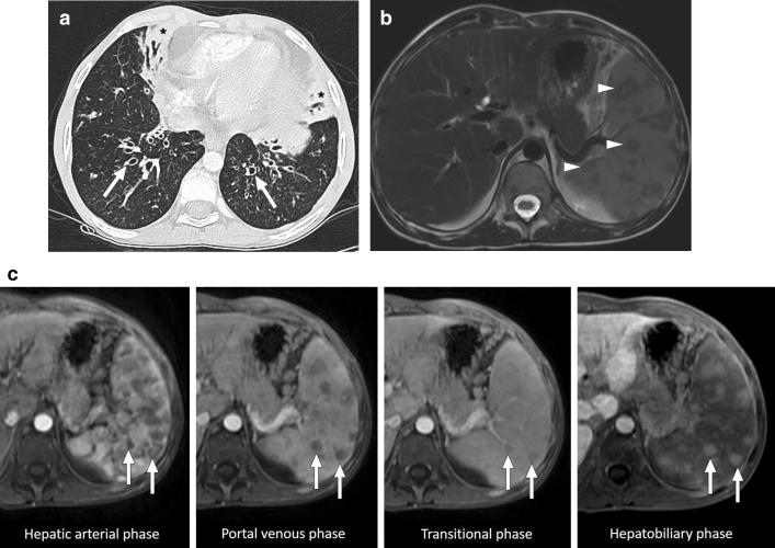 https://cdn.ncbi.nlm.nih.gov/pmc/blobs/0f0f/8160561/ea4642c8226d/261_2021_3130_Fig19_HTML.jpg