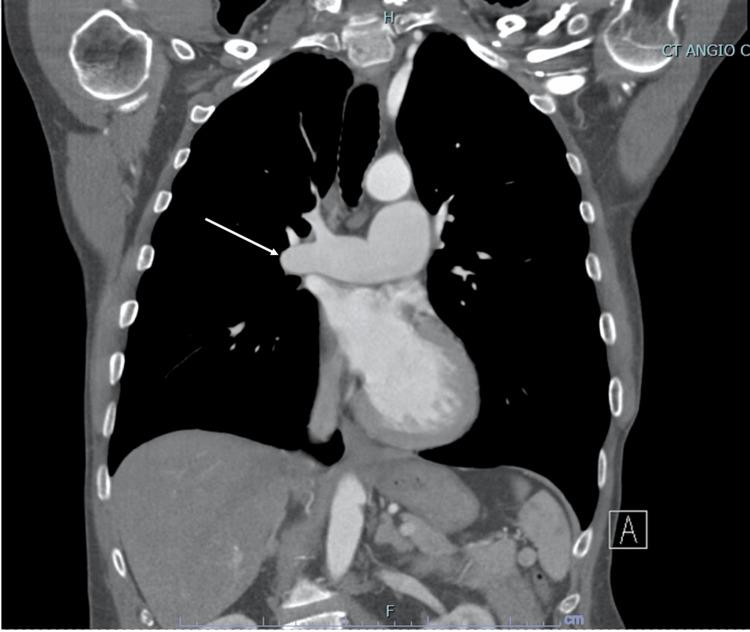 https://cdn.ncbi.nlm.nih.gov/pmc/blobs/0f49/9788795/4a62c2dc4a36/cureus-0014-00000031820-i02.jpg