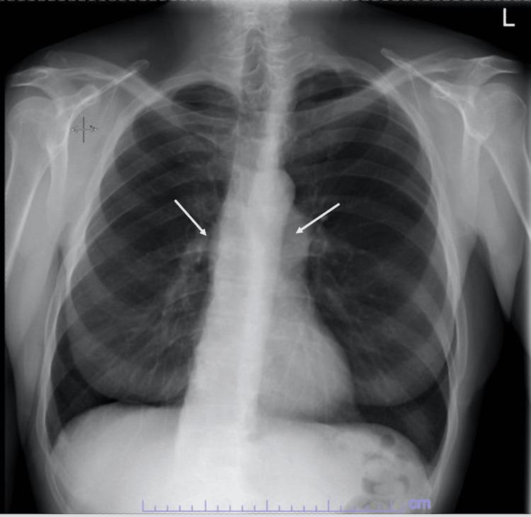 https://cdn.ncbi.nlm.nih.gov/pmc/blobs/0f49/9788795/e0ec5fe55c47/cureus-0014-00000031820-i01.jpg