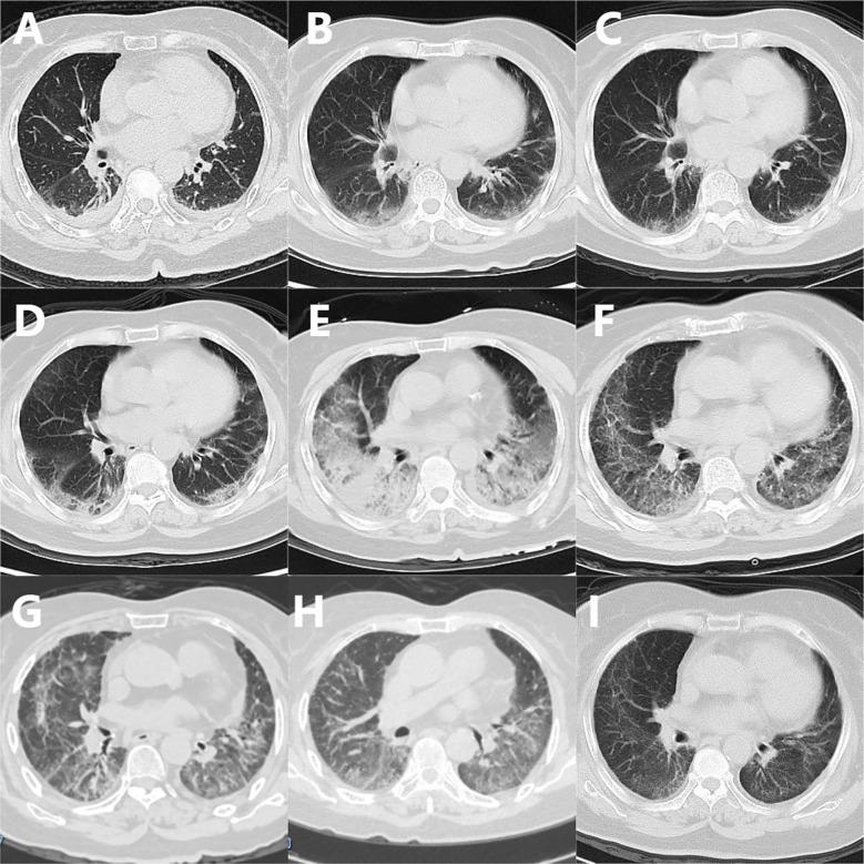 https://cdn.ncbi.nlm.nih.gov/pmc/blobs/0f58/12197957/a7b32e378a70/fimmu-16-1614777-g001.jpg