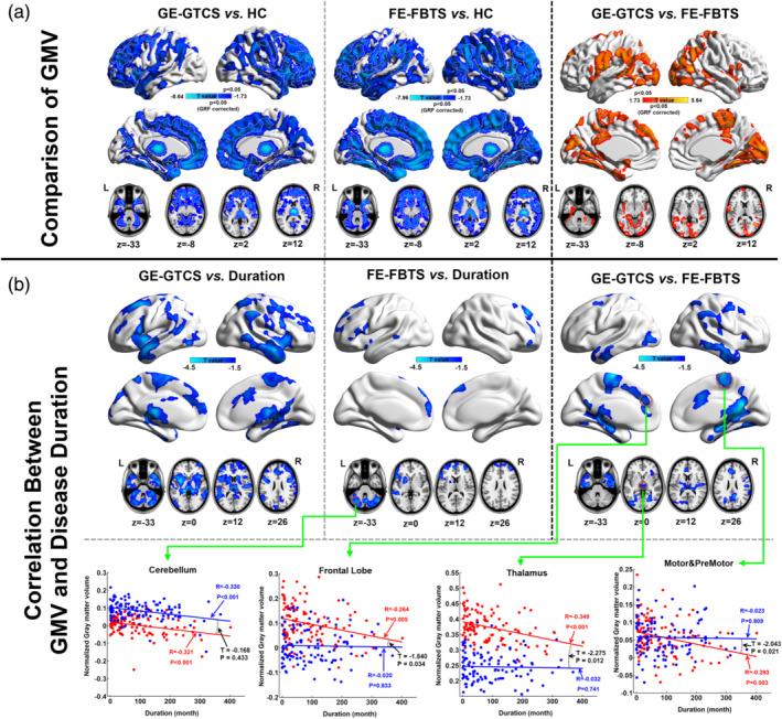 https://cdn.ncbi.nlm.nih.gov/pmc/blobs/0f7b/7856655/9ecc251760be/HBM-42-1102-g002.jpg