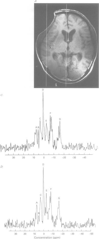 https://cdn.ncbi.nlm.nih.gov/pmc/blobs/0f84/1073990/0df064e02f65/jnnpsyc00008-0042-a.jpg