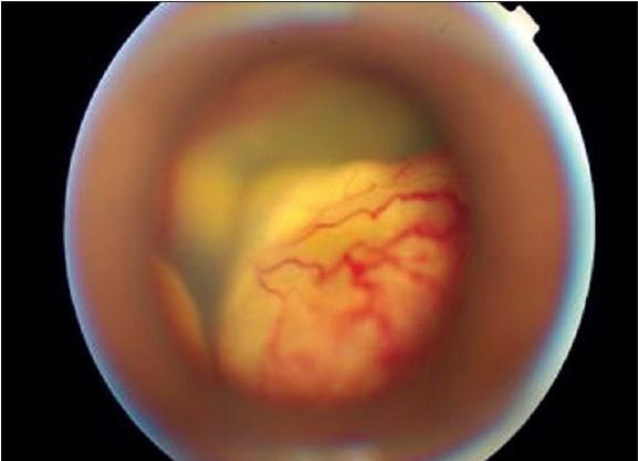 https://cdn.ncbi.nlm.nih.gov/pmc/blobs/0ff8/2841382/40520b63ffe6/IJO-58-76-g005.jpg