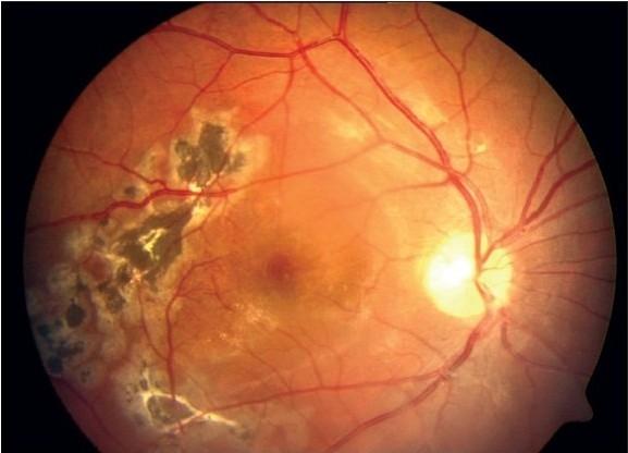 https://cdn.ncbi.nlm.nih.gov/pmc/blobs/0ff8/2841382/b2a5995ff09a/IJO-58-76-g003.jpg