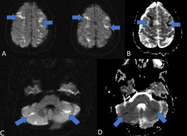 https://cdn.ncbi.nlm.nih.gov/pmc/blobs/1049/10363290/64b7361df99f/cureus-0015-00000040845-i06.jpg