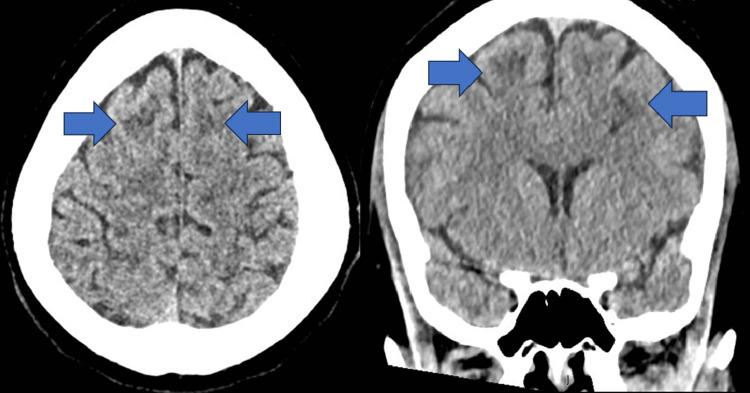 https://cdn.ncbi.nlm.nih.gov/pmc/blobs/1049/10363290/82d5fc8e52fe/cureus-0015-00000040845-i05.jpg