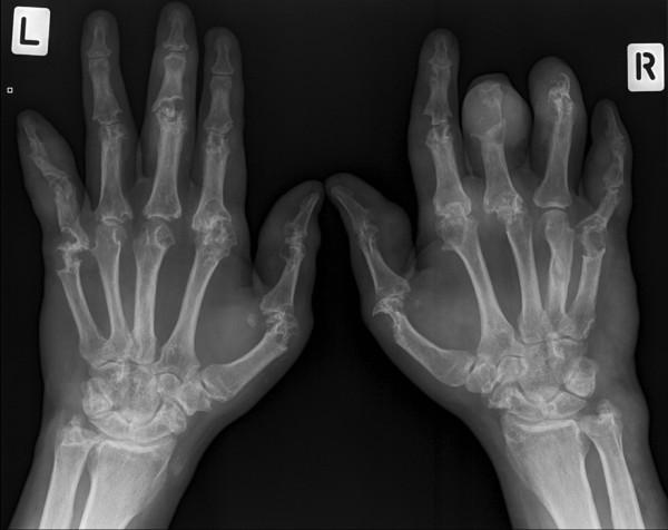 https://cdn.ncbi.nlm.nih.gov/pmc/blobs/1080/3334625/98296a7edc9e/ar3489-1.jpg