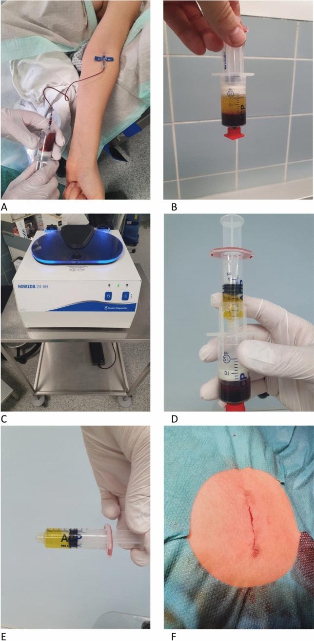 https://cdn.ncbi.nlm.nih.gov/pmc/blobs/10fa/9470624/4f6b19eb5224/404_2022_6416_Fig1_HTML.jpg