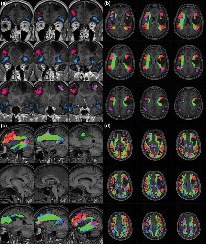 https://cdn.ncbi.nlm.nih.gov/pmc/blobs/1148/10365236/73ee7ac0d723/HBM-44-4480-g005.jpg
