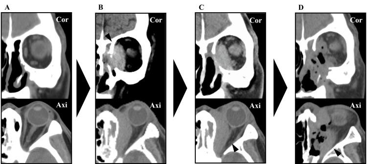 https://cdn.ncbi.nlm.nih.gov/pmc/blobs/114d/12296910/45fe72f0b898/cureus-0017-00000086809-i02.jpg