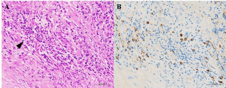 https://cdn.ncbi.nlm.nih.gov/pmc/blobs/114d/12296910/88c12bd7a18e/cureus-0017-00000086809-i06.jpg