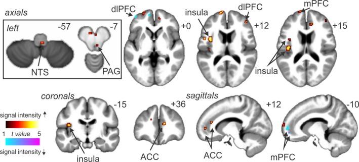 https://cdn.ncbi.nlm.nih.gov/pmc/blobs/114e/5840447/edf31dea4e9a/BRB3-8-e00888-g004.jpg