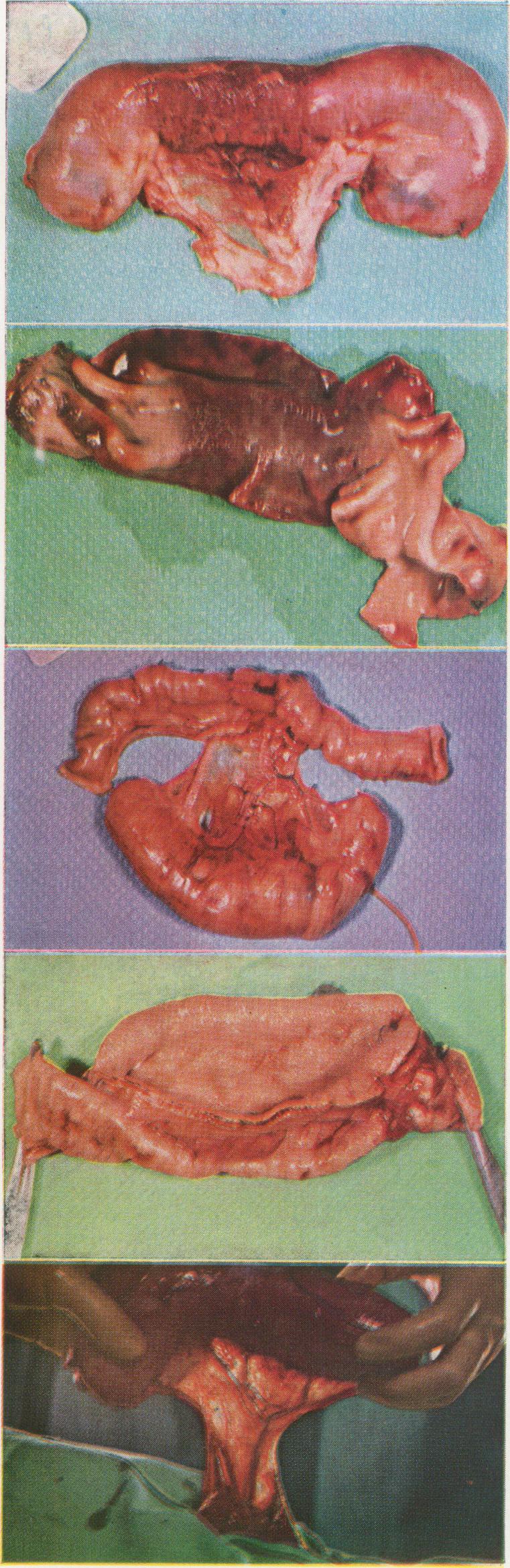 https://cdn.ncbi.nlm.nih.gov/pmc/blobs/115d/1613807/579ba14b2fa5/annsurg01286-0103-a.jpg