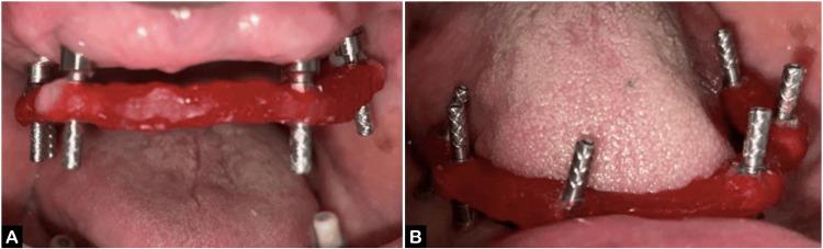 https://cdn.ncbi.nlm.nih.gov/pmc/blobs/1162/11391092/795486fb8e6b/cureus-0016-00000066732-i03.jpg