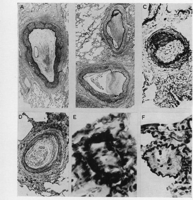 https://cdn.ncbi.nlm.nih.gov/pmc/blobs/1193/479644/db6ed14044df/brheartj00381-0112-a.jpg