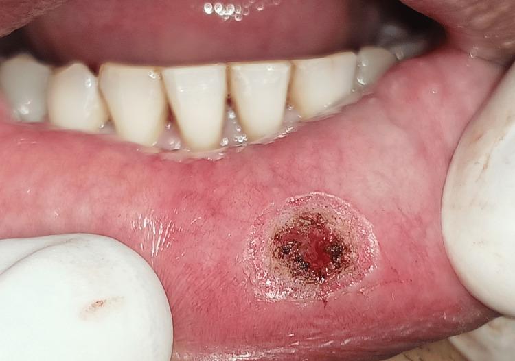 https://cdn.ncbi.nlm.nih.gov/pmc/blobs/11d8/10895208/ff1b81882639/cureus-0016-00000053020-i04.jpg