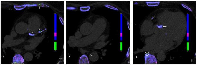 https://cdn.ncbi.nlm.nih.gov/pmc/blobs/1217/8212931/0804fec0b7d8/fmed-08-649505-g0001.jpg