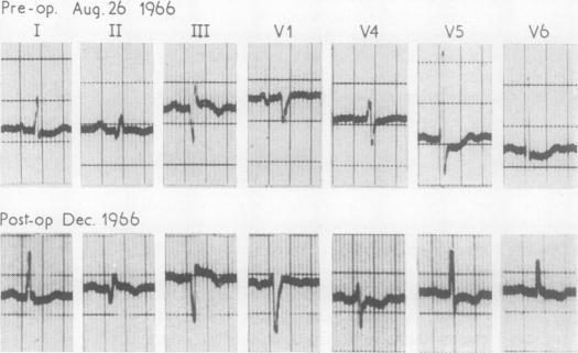 https://cdn.ncbi.nlm.nih.gov/pmc/blobs/1234/471930/c2fbd2344535/thorax00103-0126-b.jpg