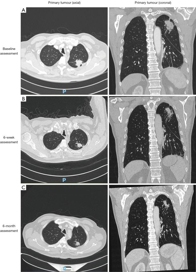 https://cdn.ncbi.nlm.nih.gov/pmc/blobs/1238/10938107/417323334351/tlcr-13-02-434-f2.jpg