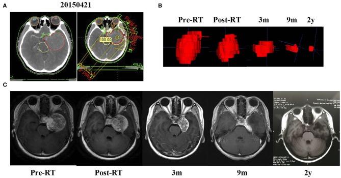 https://cdn.ncbi.nlm.nih.gov/pmc/blobs/1246/7237578/2e8086f8fc24/fneur-11-00355-g0001.jpg