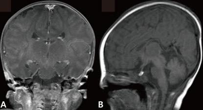 https://cdn.ncbi.nlm.nih.gov/pmc/blobs/126d/3315620/76c390d434aa/kjped-55-107-g002.jpg