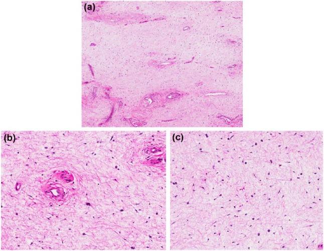 https://cdn.ncbi.nlm.nih.gov/pmc/blobs/128b/5588789/3c8c61047b2a/10.1177_2050313X17726936-fig2.jpg