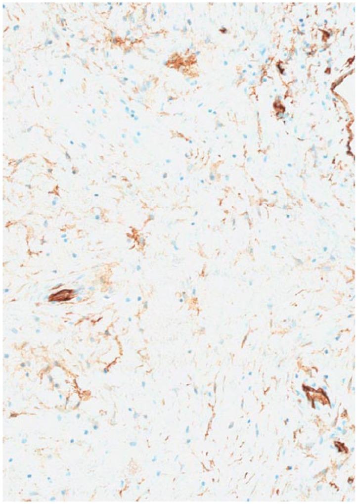 https://cdn.ncbi.nlm.nih.gov/pmc/blobs/128b/5588789/5959d0034e07/10.1177_2050313X17726936-fig4.jpg
