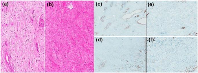 https://cdn.ncbi.nlm.nih.gov/pmc/blobs/128b/5588789/5becb6181476/10.1177_2050313X17726936-fig6.jpg