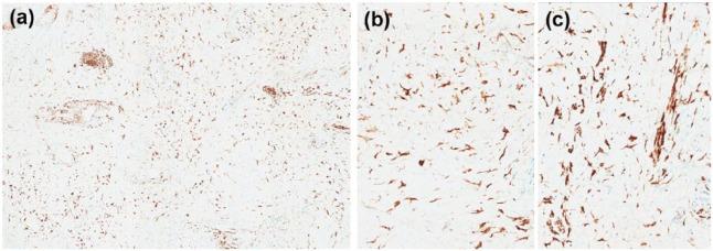 https://cdn.ncbi.nlm.nih.gov/pmc/blobs/128b/5588789/af24cd7a956b/10.1177_2050313X17726936-fig3.jpg