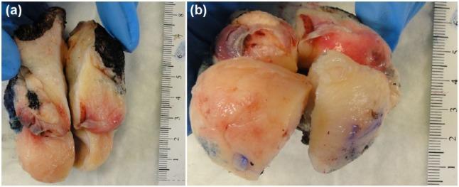 https://cdn.ncbi.nlm.nih.gov/pmc/blobs/128b/5588789/c1a32488e871/10.1177_2050313X17726936-fig1.jpg