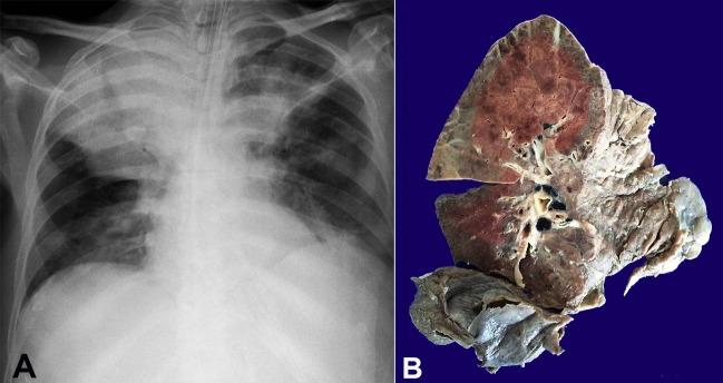 https://cdn.ncbi.nlm.nih.gov/pmc/blobs/129c/6287276/d0347fd852c7/autopsy-08-02e2018028-g01.jpg