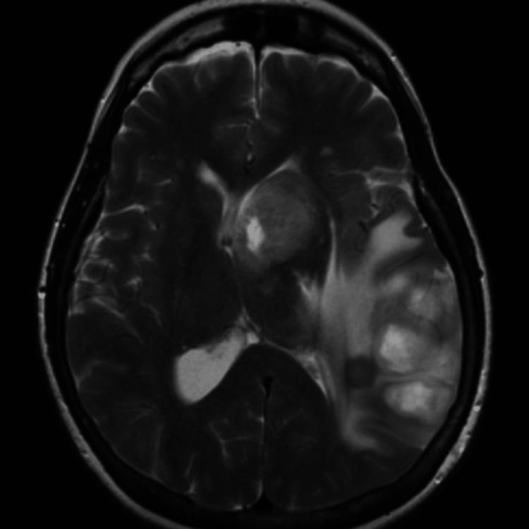 https://cdn.ncbi.nlm.nih.gov/pmc/blobs/12f1/10858374/5254f4960565/cureus-0016-00000052075-i03.jpg