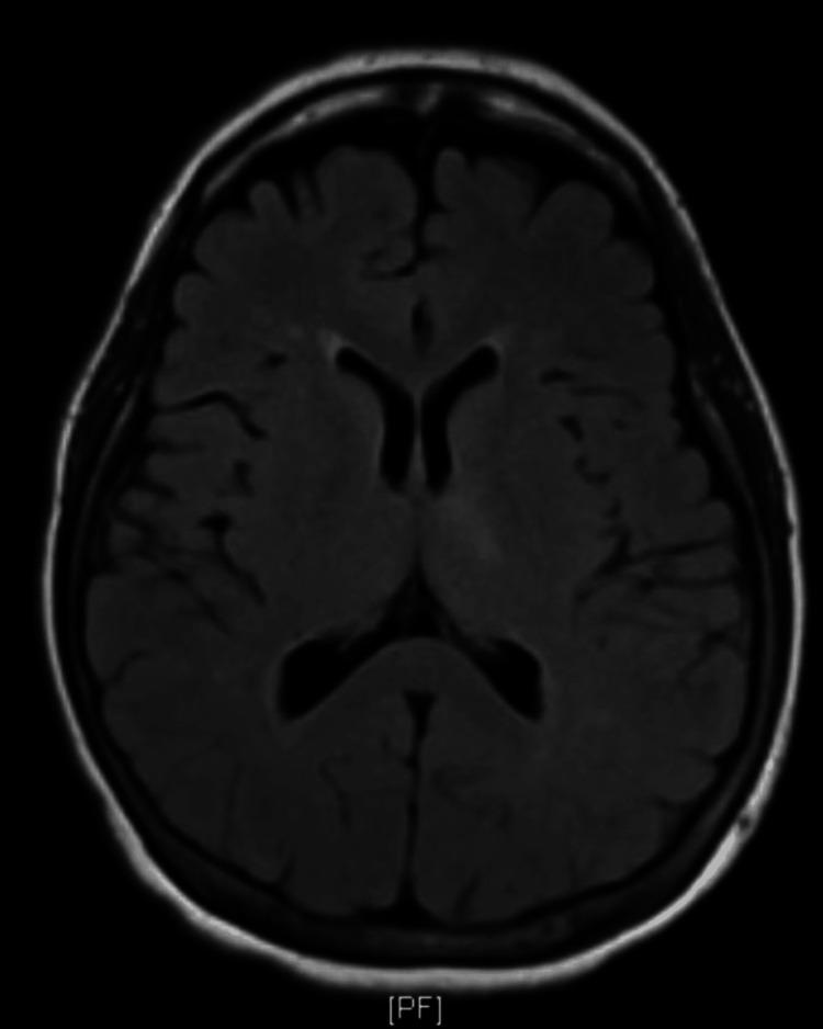 https://cdn.ncbi.nlm.nih.gov/pmc/blobs/12f1/10858374/7bc80e1ed31c/cureus-0016-00000052075-i01.jpg