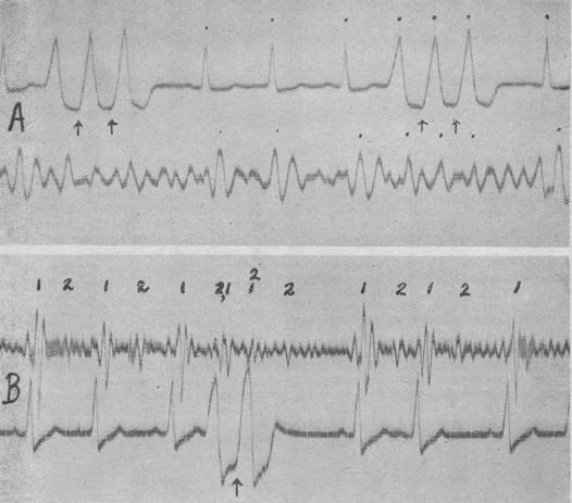 https://cdn.ncbi.nlm.nih.gov/pmc/blobs/1317/503613/956827b9454f/brheartj00411-0031-a.jpg