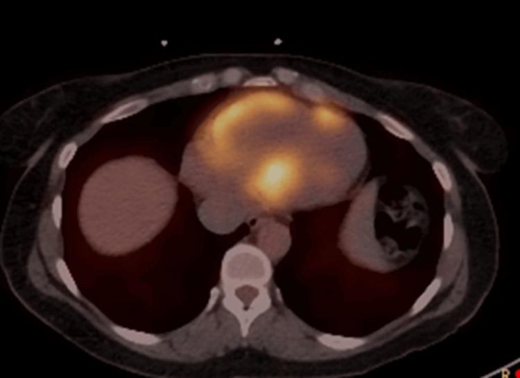 https://cdn.ncbi.nlm.nih.gov/pmc/blobs/1333/11154654/849bc53f52e8/cureus-0016-00000059783-i03.jpg