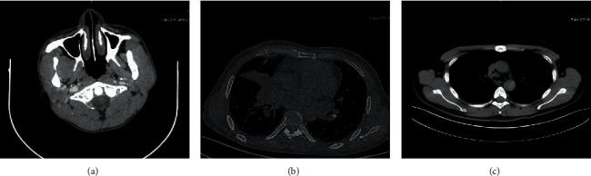 https://cdn.ncbi.nlm.nih.gov/pmc/blobs/1344/9273375/c3b90096cbd9/ECAM2022-3369895.001.jpg