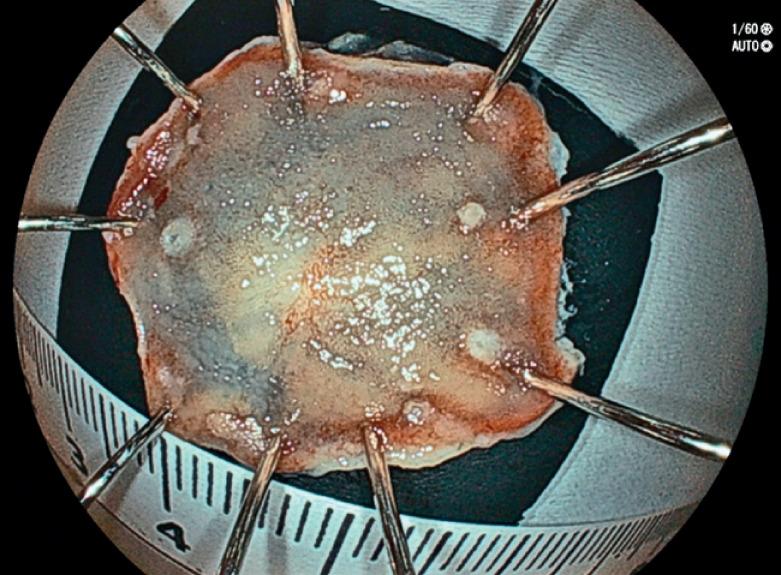 https://cdn.ncbi.nlm.nih.gov/pmc/blobs/1350/11168793/370adbc2a978/10-1055-a-2333-9313_23342889.jpg