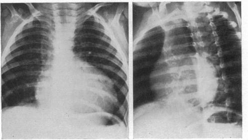 https://cdn.ncbi.nlm.nih.gov/pmc/blobs/1371/479498/9e7214f035b4/brheartj00397-0020-a.jpg
