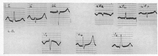 https://cdn.ncbi.nlm.nih.gov/pmc/blobs/1371/479498/a26c33bc1639/brheartj00397-0017-a.jpg