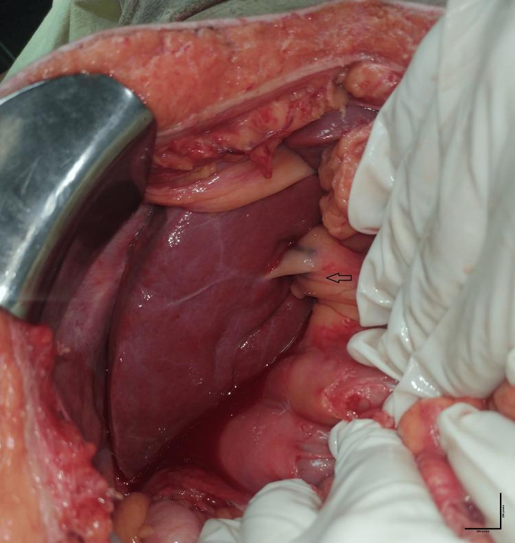 https://cdn.ncbi.nlm.nih.gov/pmc/blobs/1378/12168724/64b4ff546b97/cureus-0017-00000084200-i02.jpg