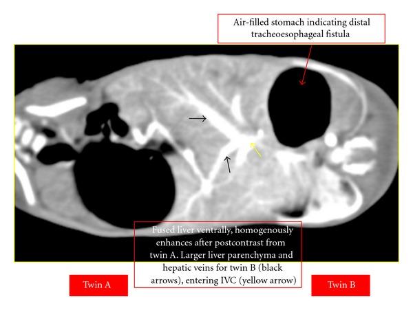 https://cdn.ncbi.nlm.nih.gov/pmc/blobs/1398/3390032/cc8ba1e4f485/CRIM.RADIOLOGY2012-564036.003.jpg