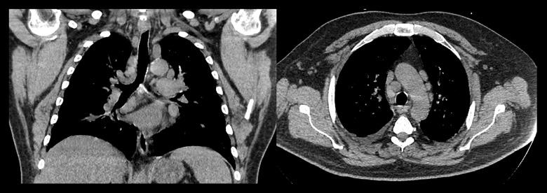 https://cdn.ncbi.nlm.nih.gov/pmc/blobs/13d0/5819310/9087e2766c2d/amjcaserep-19-163-g001.jpg