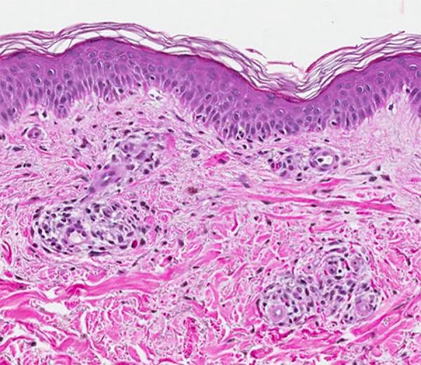 https://cdn.ncbi.nlm.nih.gov/pmc/blobs/13d0/5819310/ca952ebf3460/amjcaserep-19-163-g002.jpg