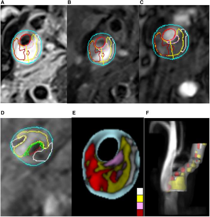 https://cdn.ncbi.nlm.nih.gov/pmc/blobs/1479/11166198/708ba3bca2e1/fcvm-11-1333908-g001.jpg