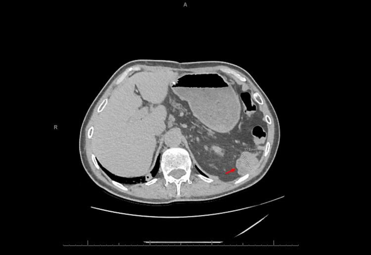 https://cdn.ncbi.nlm.nih.gov/pmc/blobs/14bc/10533948/1ab8cb8ca8cb/cureus-0015-00000044297-i02.jpg