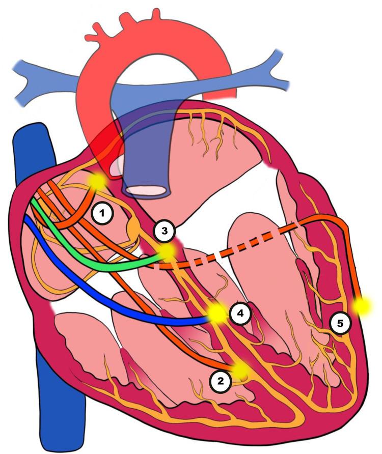 https://cdn.ncbi.nlm.nih.gov/pmc/blobs/14c3/10463741/da52f5b78e7d/fcvm-10-1220709-g003.jpg