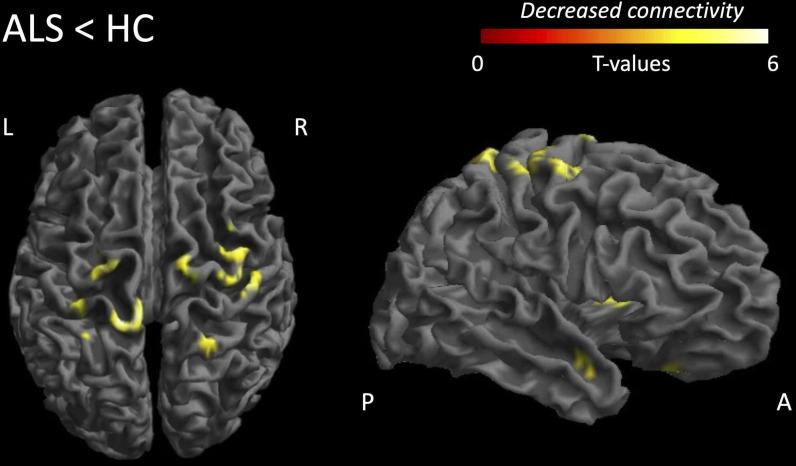 https://cdn.ncbi.nlm.nih.gov/pmc/blobs/14cc/9985743/50489dca01e7/jnnp-2022-329993f02.jpg