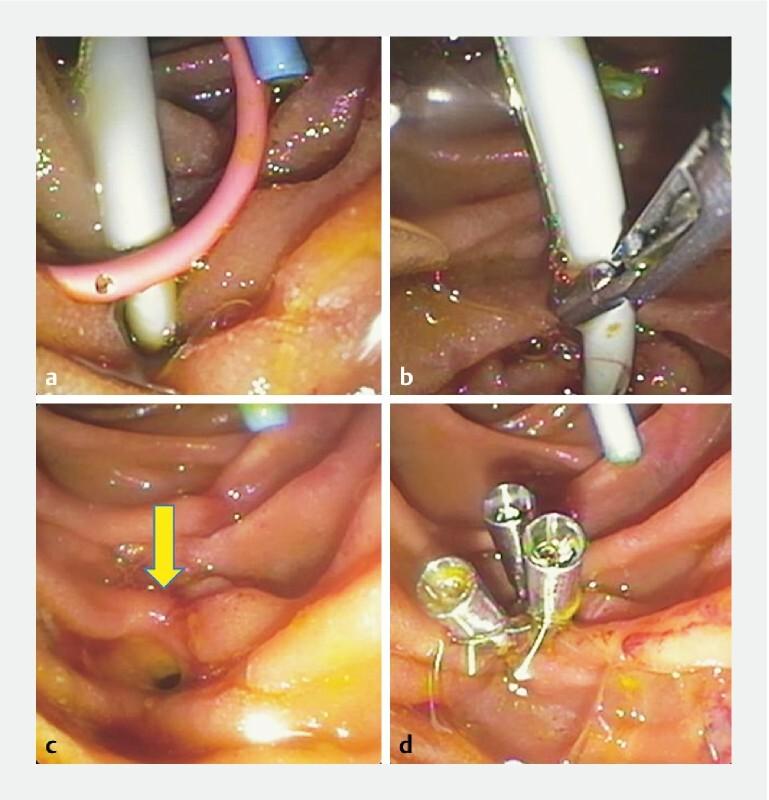 https://cdn.ncbi.nlm.nih.gov/pmc/blobs/151a/7577786/010d4f85d642/10-1055-a-1231-4758-i1799ei1.jpg